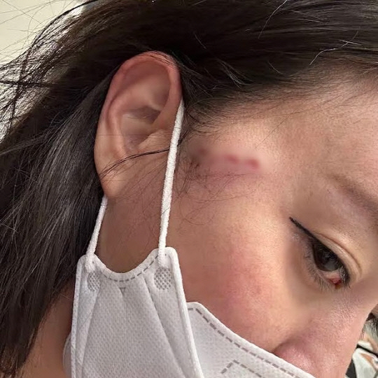 경기 부천시 부천역 근처에서 동료 BJ에게 포크로 공격당한 감성여울이 공개한 상처 사진. [유튜브 감성여울]